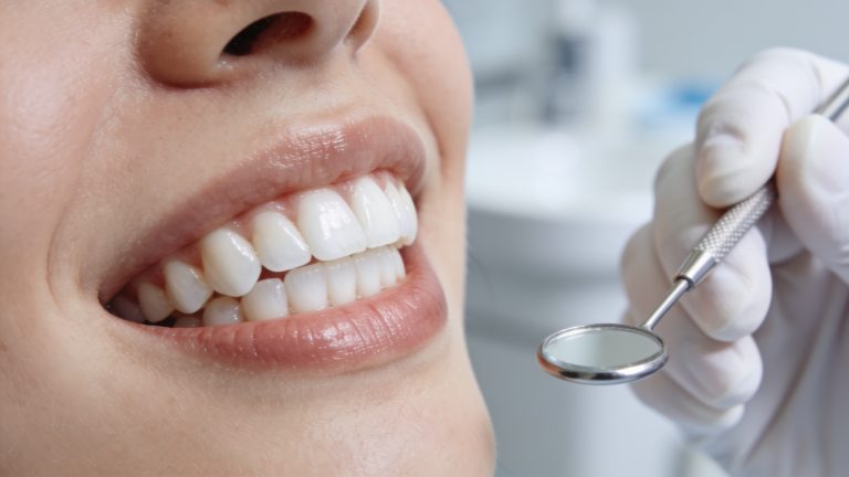 Cuando realizar un blanqueamiento dental en clinica